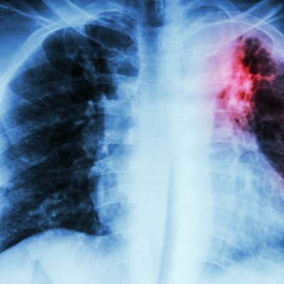 Scan-of-upper-body-showing-impact-of-tuberculosis-in-the-right-lung